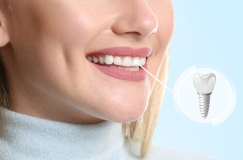 PEEK dental implants offering a metal-free, biocompatible option for tooth restoration.